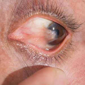 Eye with Pterygium